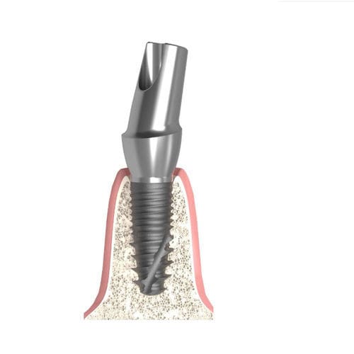 Konisches Implantat-Abutment - UNIFORM MEGAGEN® Anyone® - Bionika Medline Kft. - Titan / mit Innenverbindung / gewinkelt