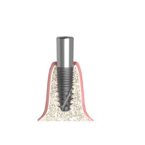 Zylindrischer Gingivaformer - Actival - Bionika Medline Kft. - mit Innenverbindung / schmal / für Zahnarztpraxis