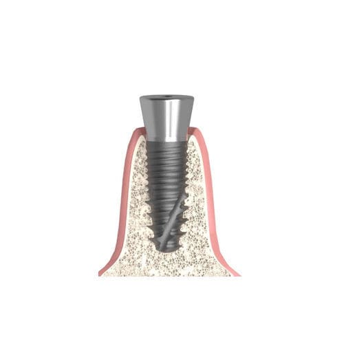 Gingivaformer / Konus zylindrisch - Actival - Bionika Medline Kft. - mit Innenverbindung / Schrauben / für Dentallabor