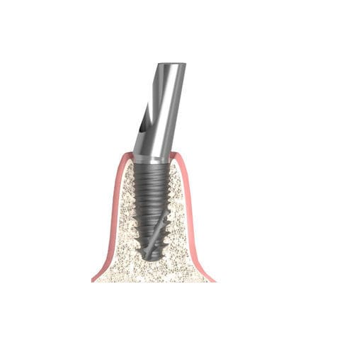 Implantat-Abutment / Konus zylindrisch - Actival - Bionika Medline Kft. - Titan / mit Innenverbindung / gewinkelt