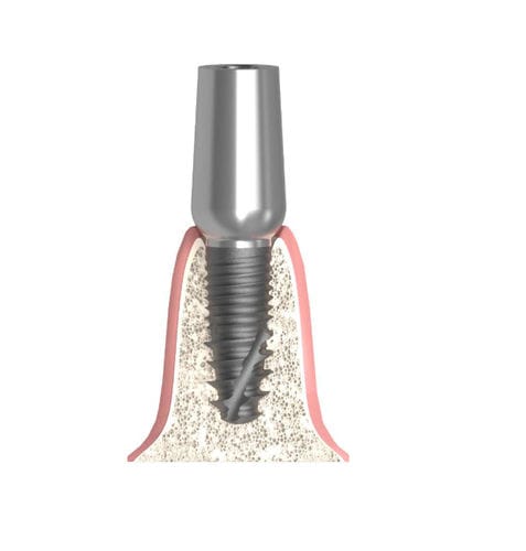 Zylindrisches Implantat-Abutment - Actival - Bionika Medline Kft. - Titan / mit Innenverbindung / gerade