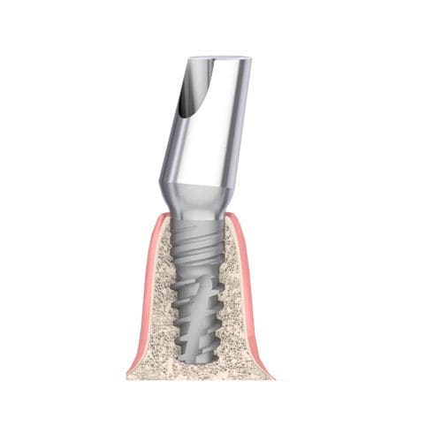 Konisches Implantat-Abutment - Actival - Bionika Medline Kft. - Titan / mit Innenverbindung / gewinkelt