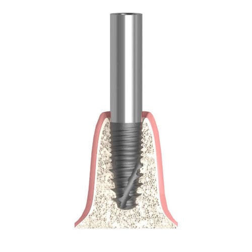 Zylindrisches Implantat-Abutment - Actival - Bionika Medline Kft. - Titan / mit Innenverbindung / gerade