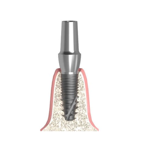 Implantat-Abutment / Konus zylindrisch - Actival - Bionika Medline Kft. - Titan / mit Innenverbindung / anatomisch