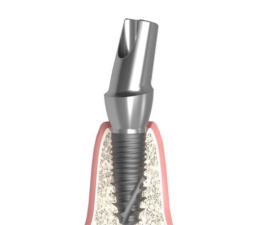 Konisches Implantat-Abutment - Actival - Bionika Medline Kft. - Titan / sechseckig / mit Innenverbindung