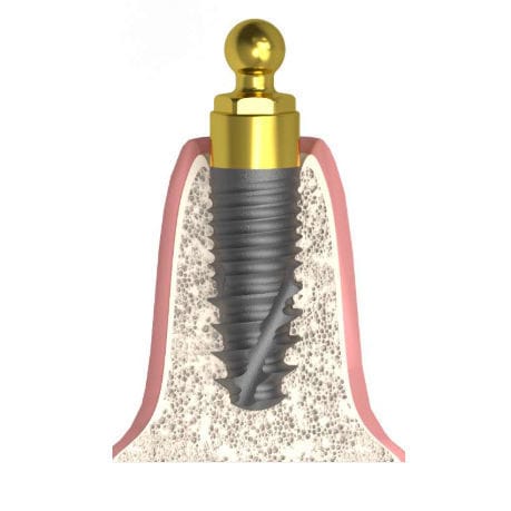 Zylindrisches Implantat-Abutment - Actival - Bionika Medline Kft. - Kugel / gerade / für Zahnarztpraxis