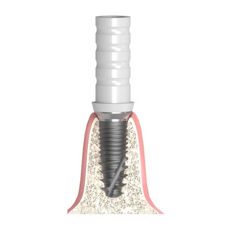 Implantat-Abutment / Konus zylindrisch - Actival - Bionika Medline Kft. - Titan / Kunststoff / mit Innenverbindung