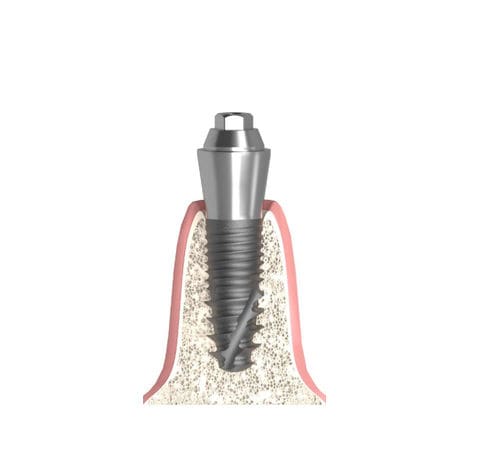 Implantat-Abutment / Konus zylindrisch - Actival - Bionika Medline Kft. - konisch / mit Innenverbindung / Multi-Unit