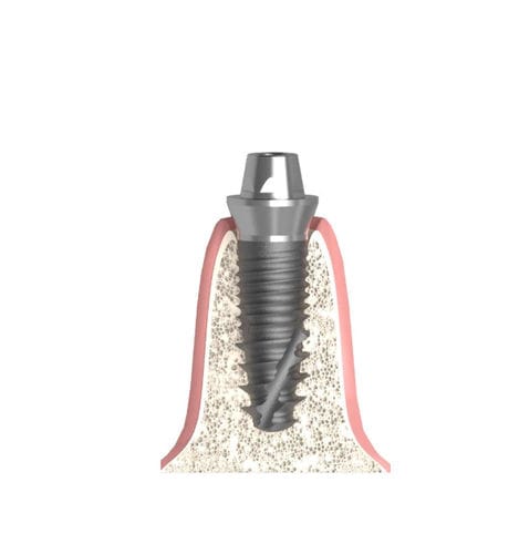 Implantat-Abutment / Konus zylindrisch - Actival - Bionika Medline Kft. - konisch / mit Innenverbindung / gerade