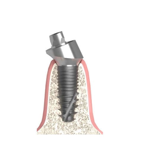 Implantat-Abutment / Konus zylindrisch - 517.894.300.010 - Bionika Medline Kft. - mit Innenverbindung / gewinkelt / Multi-Unit