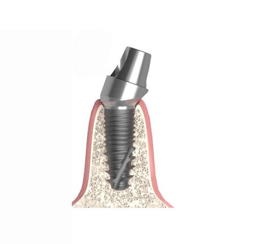 Implantat-Abutment / Konus zylindrisch - Actival - Bionika Medline Kft. - mit Innenverbindung / gewinkelt / Multi-Unit