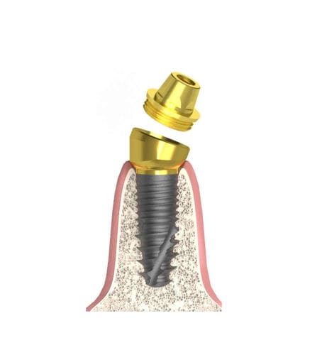 Konisches Implantat-Abutment - Actival - Bionika Medline Kft. - konisch / mit Innenverbindung / gewinkelt