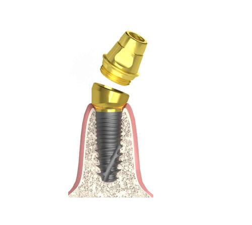 Konisches Implantat-Abutment - Actival - Bionika Medline Kft. - Titan / konisch / mit Innenverbindung