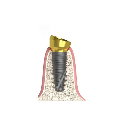 Implantat-Abutment / Konus zylindrisch - Actival - Bionika Medline Kft. - Titan / konisch / mit Innenverbindung