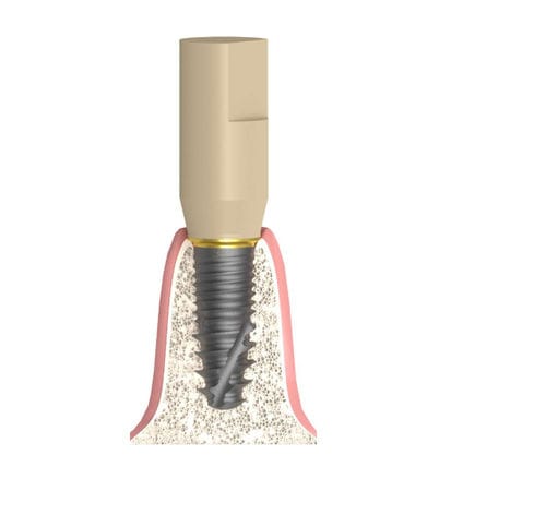 Intraoraler Scankörper - Bioplant - Bionika Medline Kft.
