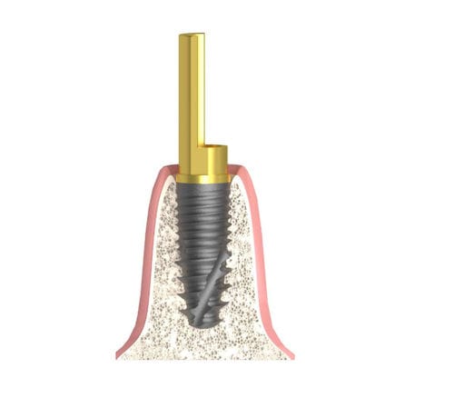Zylindrisches Implantat-Abutment - Bioplant - Bionika Medline Kft. - Titan / sechseckig / mit Innenverbindung