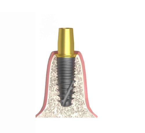 Zylindrisches Implantat-Abutment - Bioplant - Bionika Medline Kft. - Titan / sechseckig / mit Innenverbindung