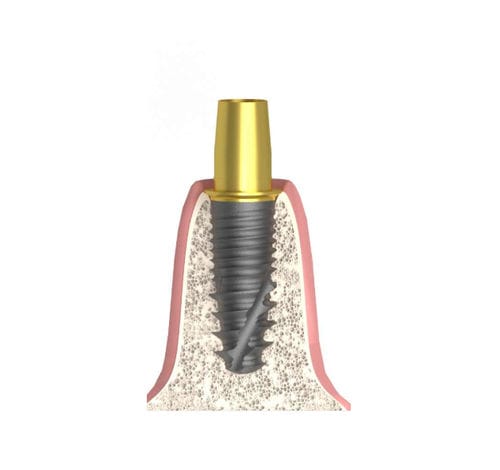Implantat-Abutment / Konus zylindrisch - UNIFORM DIO® UF - Bionika Medline Kft. - Titan / mit Innenverbindung / gerade