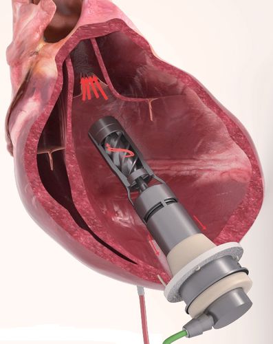 Ventrikuläres Unterstützungssystem / für Erwachsene - FLOWMAKER ® - FineHeart