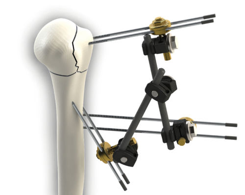 Fixateur externe / für Humerus - T-FixUp - DIAL Medicali - rohrförmig / für Erwachsene