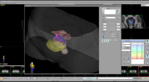 Software für Brachytherapie - BrachyCare - Técnicas Radiofísicas S.L.U. - Umform / Planung / Import