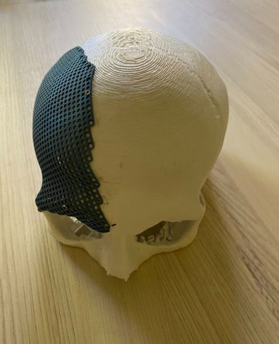 Patientenspezifisches Schädelimplantat - hb ortho