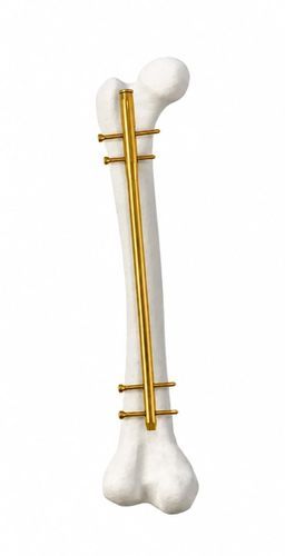 Marknagel / Humerus - 10110 series - hb ortho - Titan