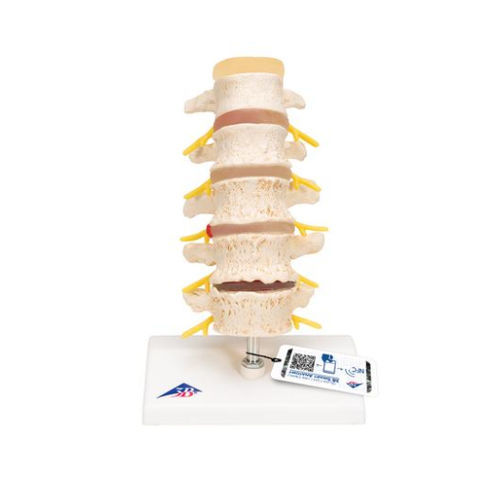 Anatomisches Modell / Wirbel - A795  - 3B Scientific   - für die Ausbildung / Hernia / exartikuliert