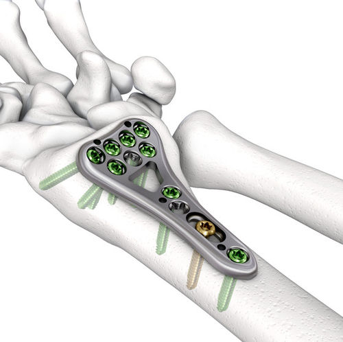 Kompressionsplatte für Radius - LOQTEQ® VA 2.5 - aap Implantate - distal / mit Verriegelung / Metall