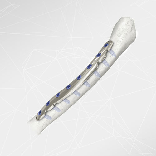 Kompressionsplatte für Schlüsselbein - LOQTEQ® 2.7 - aap Implantate - seitlich / medial / mit Verriegelung