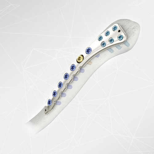 Kompressionsplatte für Schlüsselbein - LOQTEQ® 2.7 - aap Implantate - seitlich / mit Verriegelung / Metall