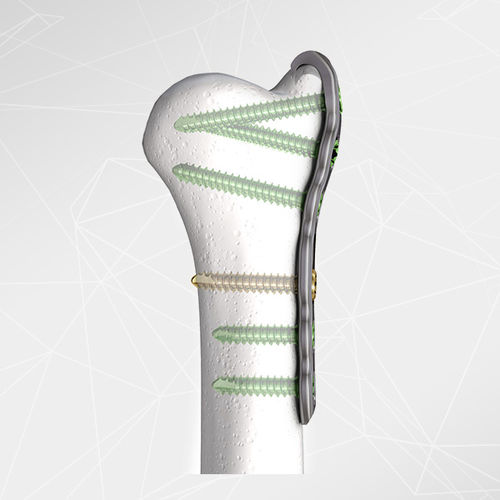 Kompressionsplatte für Ulna - aap Implantate - distal / medial / Metall