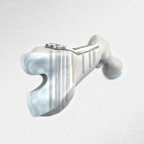 Kompressionsplatte für Oberschenkelknochen - LOQTEQ® 4.5 - aap Implantate - distal / seitlich / mit Verriegelung