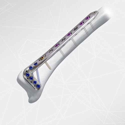 Kompressionsplatte für Tibia -  LOQTEQ® 3.5 - aap Implantate - distal / anterolateral / mit Verriegelung