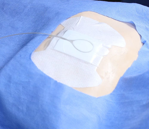 Fixierung für Intravenös-Katheter - Lock Plus - ACE Medical   - Körper / klebbar