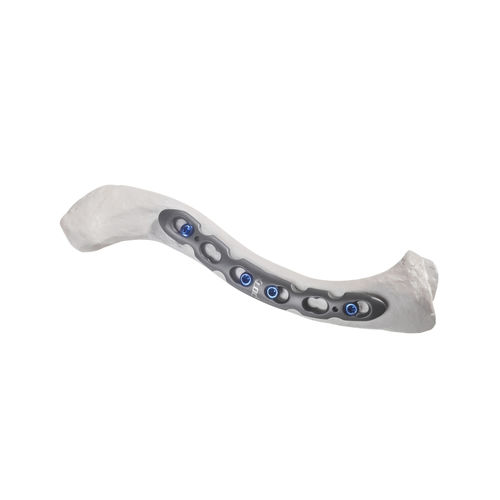 Kompressionsplatte für Schlüsselbein - 10-54766 - AF Medical   - anterolateral / mit Verriegelung / Metall