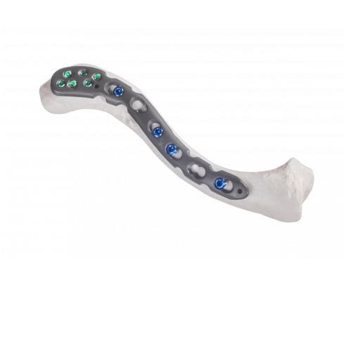 Kompressionsplatte für Schlüsselbein - 10-54813 - AF Medical   - anterolateral / mit Verriegelung / Metall