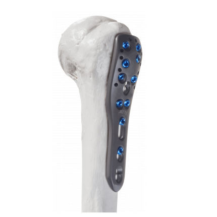 Kompressionsplatte für Humerus - 10-54003 - AF Medical   - proximal / mit Verriegelung / Metall