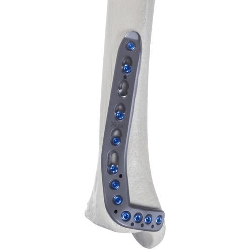 Kompressionsplatte für Tibia - 10-55 series - AF Medical   - distal / anterolateral / mit Verriegelung
