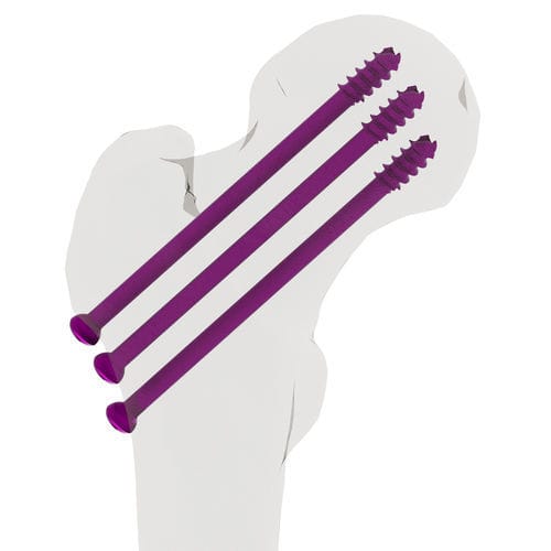 Knochen-Kompressionsschraube / für Handgelenk - 15-02800 - AF Medical   - für Tibia / für Oberschenkelknochen / für Oberschenkelknochen