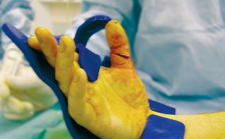 Handauflage für orthopädische Chirurgie - KIROFIX Large - AKED