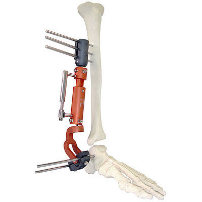 Fixateur externe / für Knöchel - 567 - BAUMER  - rohrförmig / für Erwachsene