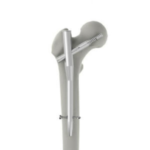 Marknagel für Oberschenkelknochen - INTERNA® PFN - BAUMER  - mit proximaler Fixierung / Metall