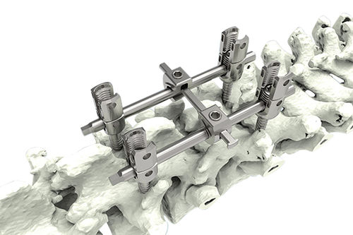 Pedikelschraube für Lumbal-Thorakal-Wirbel - M10-Ia - Waston medical - polyaxial / monoaxial / Titan