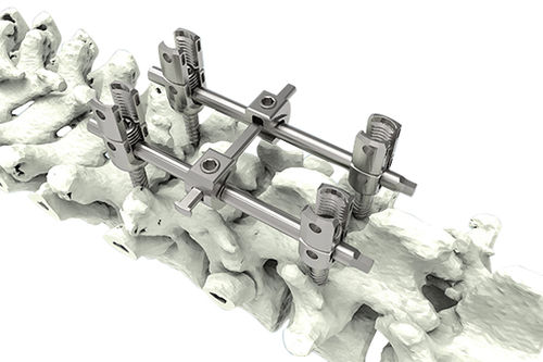 Thorako-lumbale Pedikelschraube - M9-Ia - Waston medical - polyaxial / monoaxial / Titan