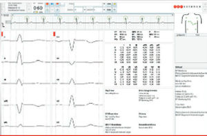 Diagnosealgorithmus - ECG algorithms - Corscience GmbH & Co. KG - Analyse / für EKG