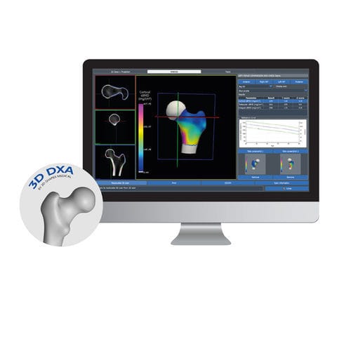 Software für Knochendichtemessung - 3D-DXA - DMS Imaging - 3D-Visualisierung