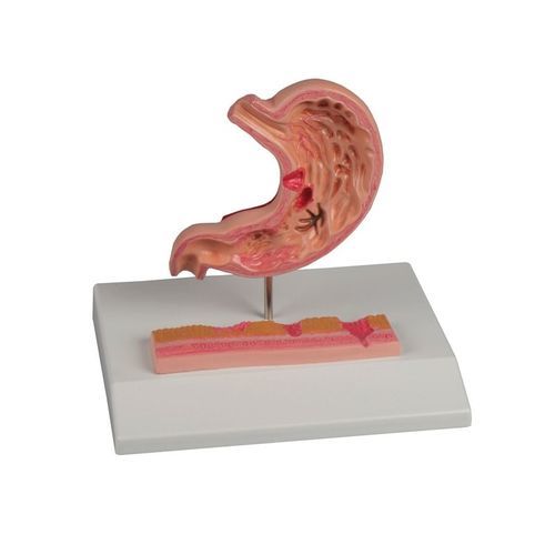 Anatomisches Magenmodell - K217 - Erler-Zimmer - Zwölffingerdarm / Speiseröhre
