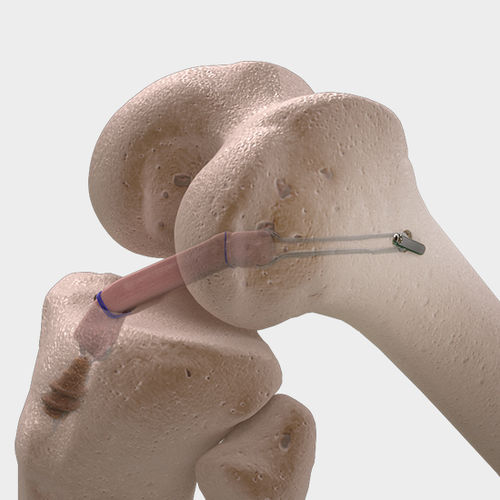 Bandersatz / vordere Kreuzbänder - CorTTape® - FH Orthopedics - vorderes Kreuzband / synthetisch