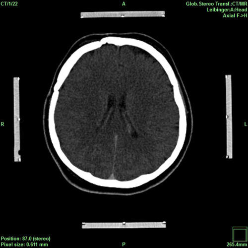 Planungssoftware - iPS - inomed Medizintechnik - Kontroll / für Neurochirurgie / für stereotaktische Neurochirurgie